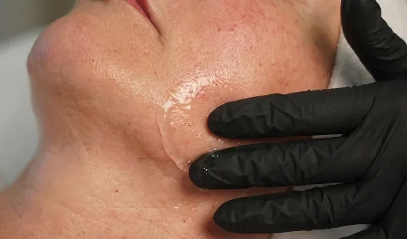 Beruhigendes Serum wird nach dem Microneedling auf die leicht gerötete Wange der Kundin aufgetragen