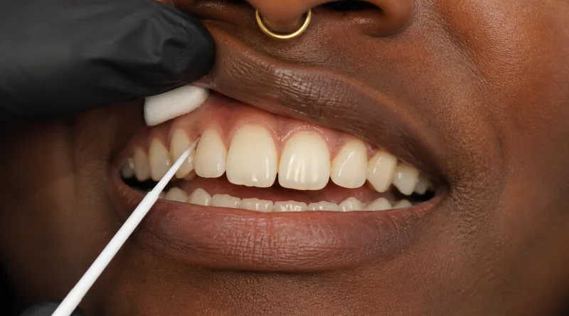 Makroaufnahme: Eine kleine Watterolle hält den oberen seitlichen Schneidezahn trocken, während ein Microbrush den Haftvermittler aufträgt